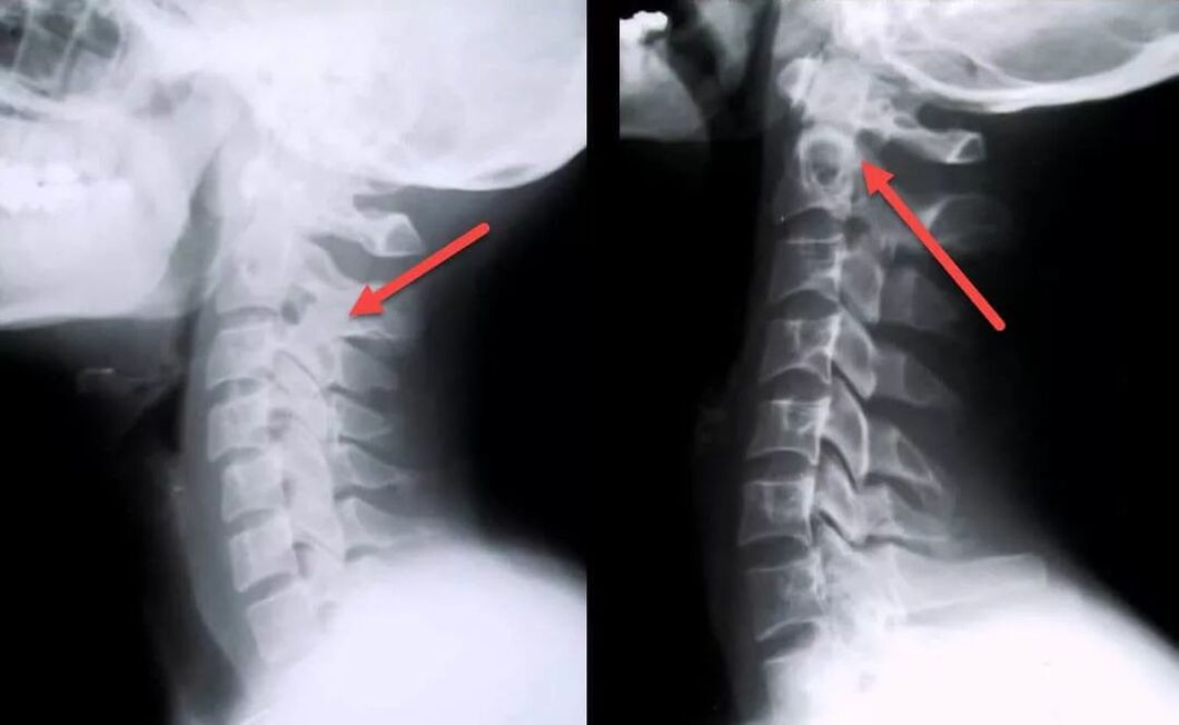 Diagnóstico da osteocondrose cervical