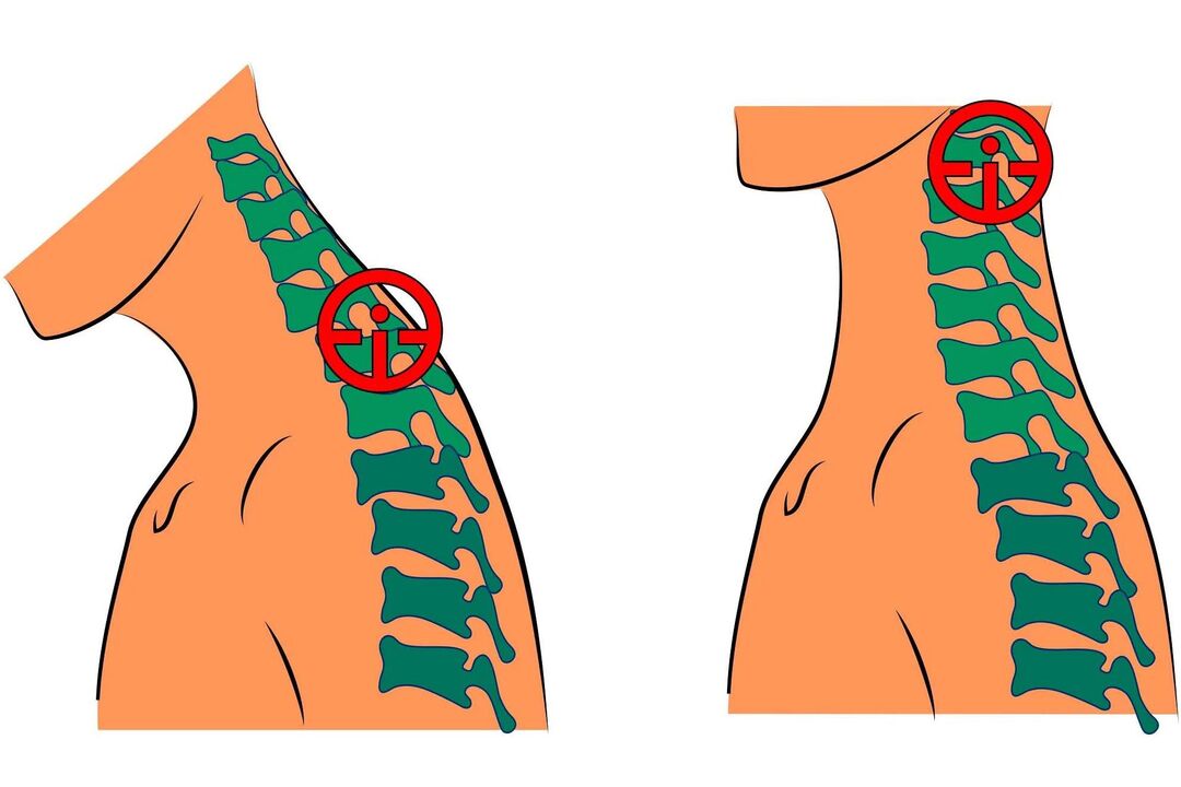 osteocondrose cervical