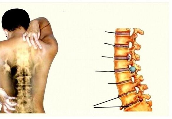 Estadios de osteocondrose cervical