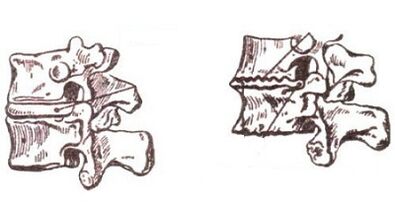 Etapas de desenvolvemento da osteocondrose do cérvix