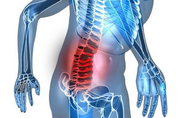 Deformidade da columna vertebral na cuarta etapa da osteocondrose lumbar