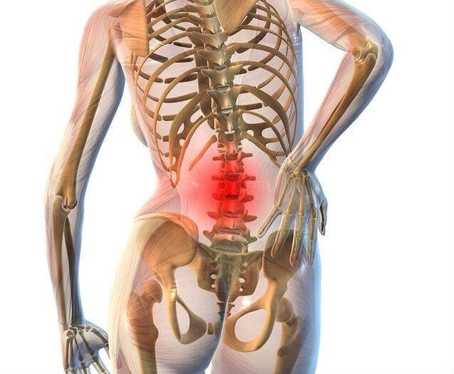 Osteocondrose da columna lumbar