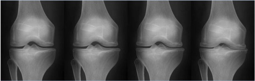 Etapas da osteoartrite segundo a clasificación de Kellgren-Lawrence