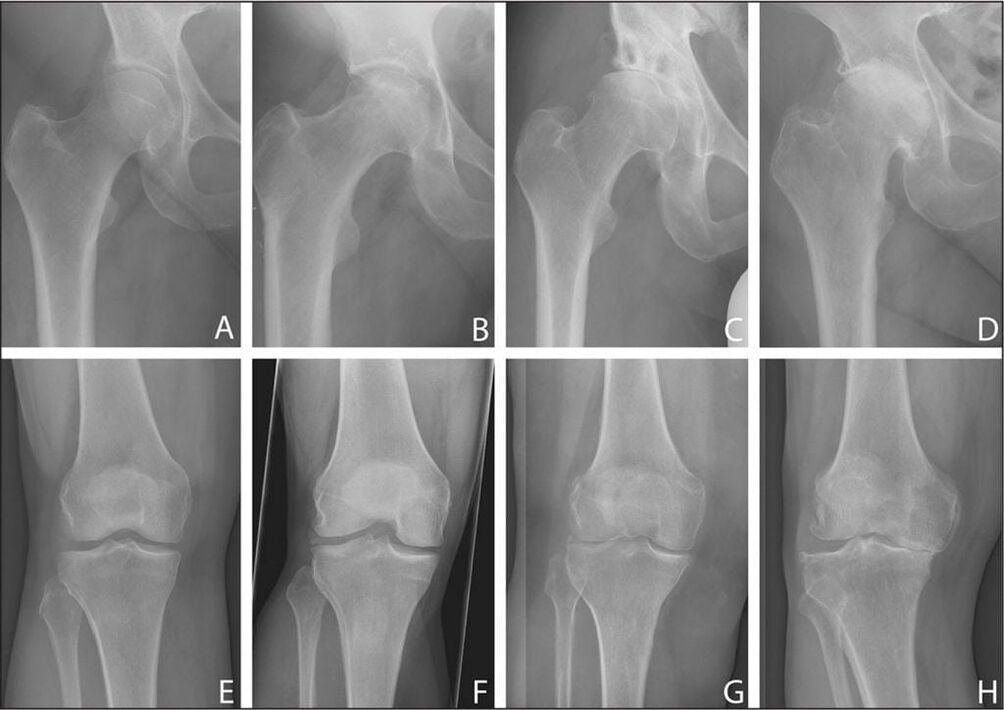 Fases de desenvolvemento da artrose articular na imaxe de raios X